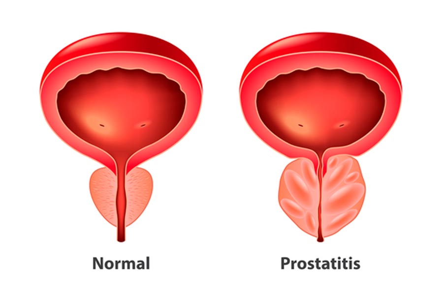 prostatitis